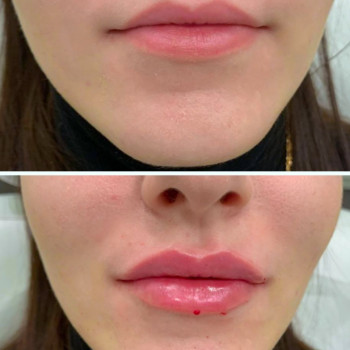 Контурная пластика губ
                    Kosmetyczka Natalia Sambur Omsk