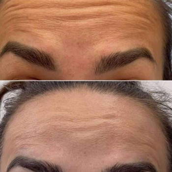 Ботулинатерапия
                    Kosmetikerin Natalia Sambur Omsk