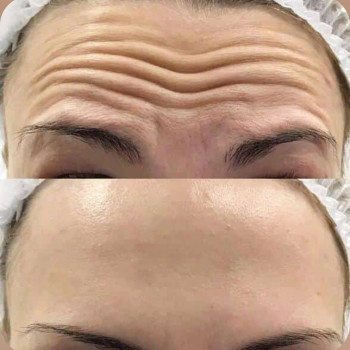 Ботулинатерапия
                    Kosmetikerin Natalia Sambur Omsk