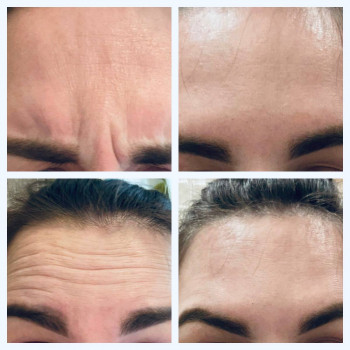 Ботулинатерапия
                    Kosmetikerin Natalia Sambur Omsk