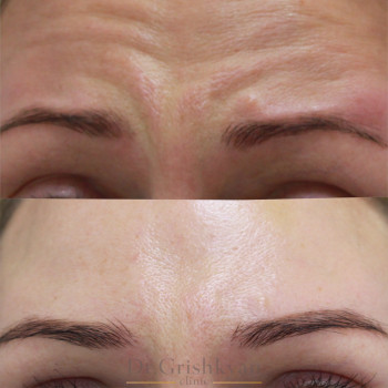 Ботулинатерапия
                    Kosmetikerin Natalia Sambur Omsk