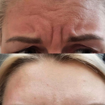 Ботулинатерапия
                    Kosmetikerin Natalia Sambur Omsk