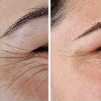 Ботулинатерапия
                    Kosmetikerin Natalia Sambur Omsk