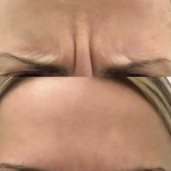 Ботулинатерапия
                    Kosmetikerin Natalia Sambur Omsk