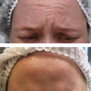 Ботулинатерапия
                    Kosmetikerin Natalia Sambur Omsk