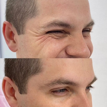 Ботулинатерапия
                    Kosmetikerin Natalia Sambur Omsk