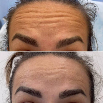 Ботулинатерапия
                    Kosmetikerin Natalia Sambur Omsk