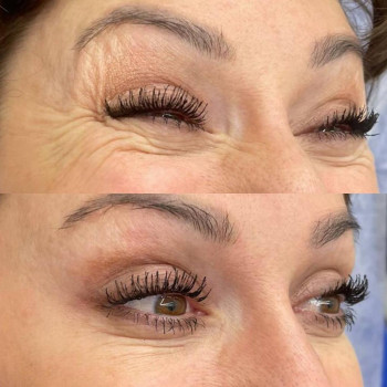 Ботулинатерапия
                    Kosmetikerin Natalia Sambur Omsk