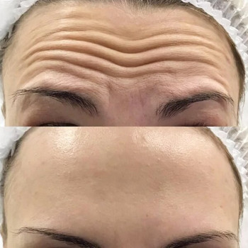 Ботулинатерапия
                    Kosmetikerin Natalia Sambur Omsk