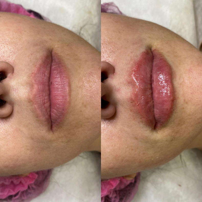 Lip augmentation #lip augmentation #fillers for lips #lips, photo - Tattoo Master Barb Tattoo