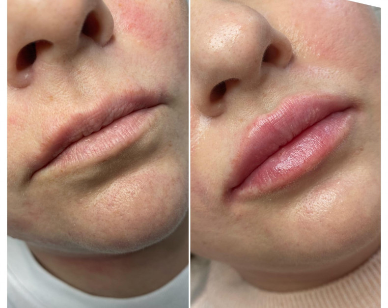 Lips #lip augmentation #lips #lips #moisturizinglips, photo - Tattoo Master Barb Tattoo