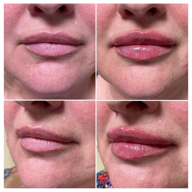 Lippenkonturierung #Lippen #Lippen #Lippenvergrößerung #Lippenbogen, photo - Tattoo-Meister Barb Tattoo