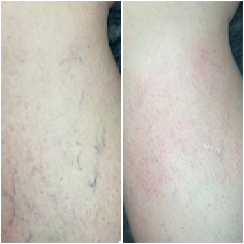 Удаление сосудов (купероз)
                    Specjalista od depilacji Irina Irina Wrocław