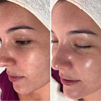 Массаж лица. Эстетическая косметология.
                    Массажист Светлана Митина Саратов