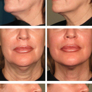 Массаж лица. Эстетическая косметология.
                    Массажист Светлана Митина Саратов