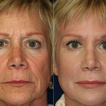 Массаж лица. Эстетическая косметология.
                    Массажист Светлана Митина Саратов