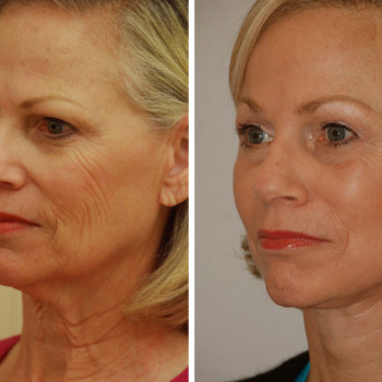 Массаж лица. Эстетическая косметология.
                    Массажист Светлана Митина Саратов