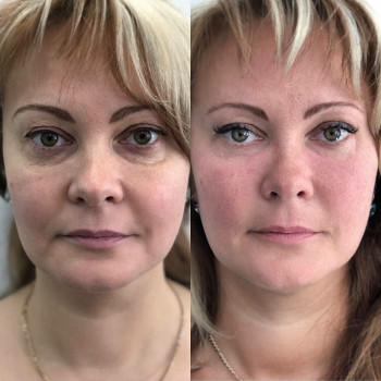 Массаж лица. Эстетическая косметология.
                    Массажист Светлана Митина Саратов