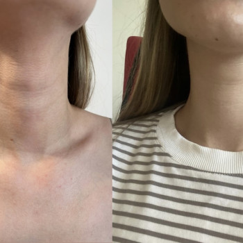 Избавляемся от колец Венеры