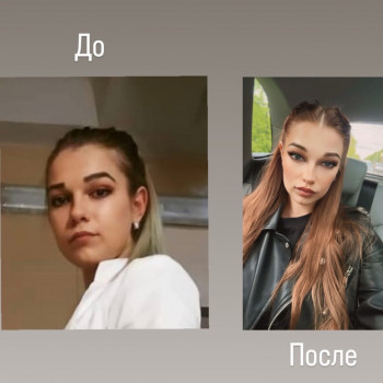 Итог коррекции лица с помощью тейпов