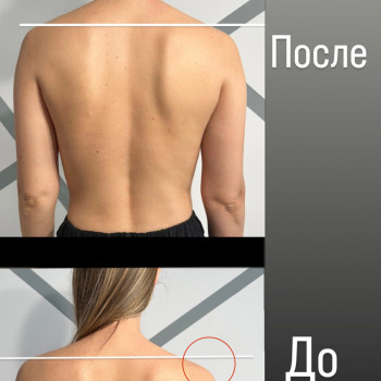 Всего 1 сеанс тейпирования для коррекции осанки