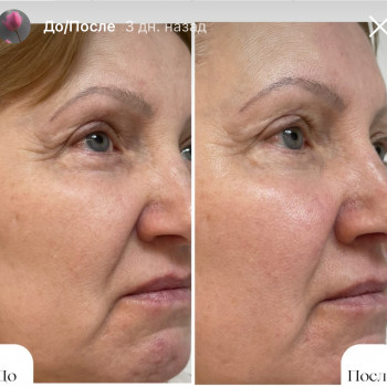 Миофасциальный массаж