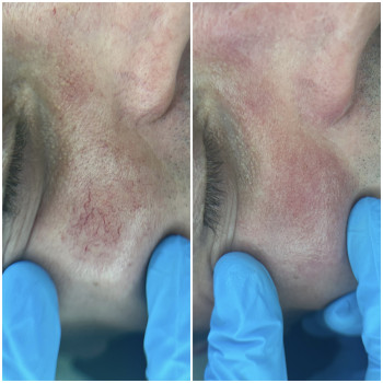 Удаление сосудов, удаление купероза
                    Meister der Haarentfernung Irina Irina Wroclaw