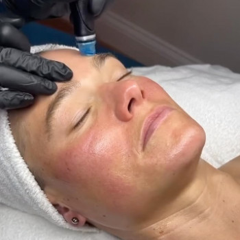 Чистка лица HydraFacial