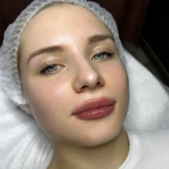 Microneedling