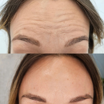 Лечение гипергидроза (Botox)