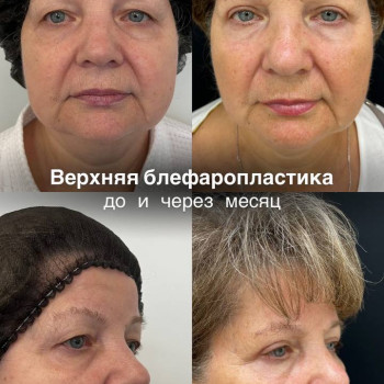 Удаление комков Биша
