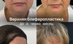 Пластика верхних век Klinik für Plastische Chirurgie  Эталон Moscow