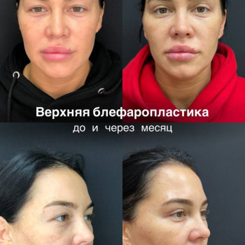 Пластика верхних век