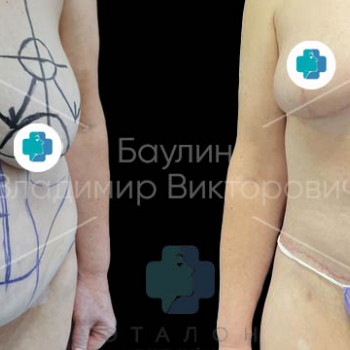 Абдоминопластика (пластика живота)