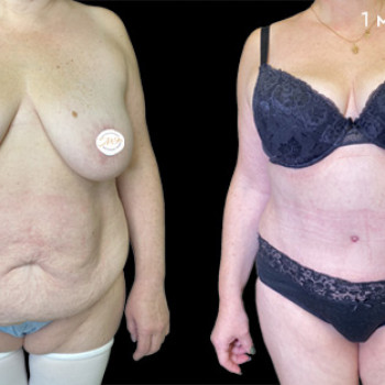 Абдоминопластика (пластика живота)
                    Клиника пластической хирургии Эталон Москва