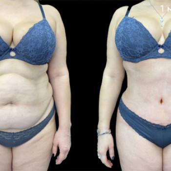 Абдоминопластика (пластика живота)
                    Клиника пластической хирургии Эталон Москва