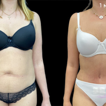 Абдоминопластика (пластика живота)
                    Клиника пластической хирургии Эталон Москва