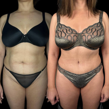 Абдоминопластика (пластика живота)
                    Клиника пластической хирургии Эталон Москва