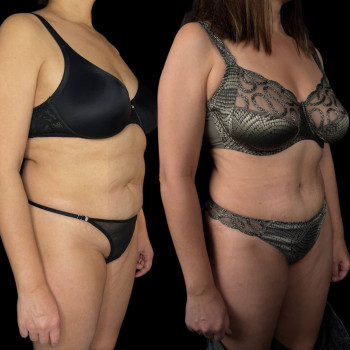 Абдоминопластика (пластика живота)
                    Клиника пластической хирургии Эталон Москва