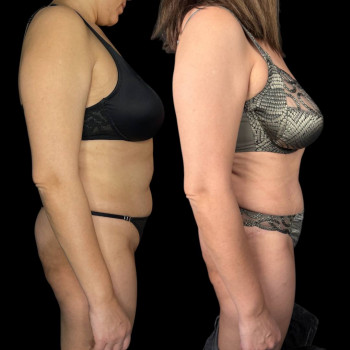 Абдоминопластика (пластика живота)
                    Клиника пластической хирургии Эталон Москва