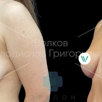 Подтяжка груди