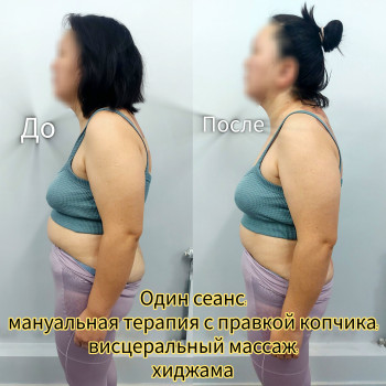 Мануальная терапия и хиджама