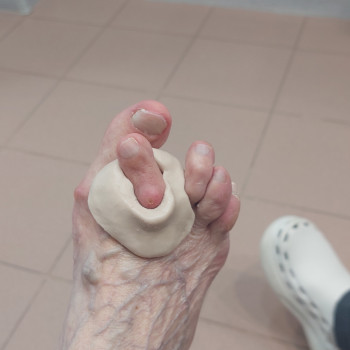 Удаление натоптышей