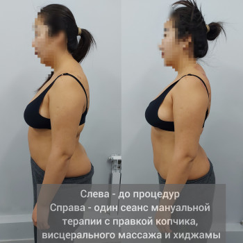 Слева - до процедур 
Справа - один сеанс мануальной 
терапии
