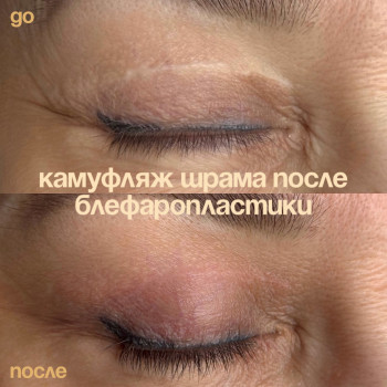 Удаление тату, татуажа, стрелок, перманентного макияжа