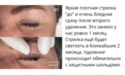 Удаление тату, татуажа, стрелок, перманентного макияжа Мастер перманентного макияжа, трихопигментации Алена Бодрова Санкт-Петербург