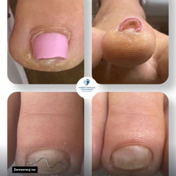 Masz problem z wkręcającym się paznokciem? Klamra UniBrace to szybka i bezbolesna pomoc! Już po założeniu odczujesz natychmiastową ulgę i zmniejszenie bólu. Dyskretny, estetyczny sposób na poprawę komfortu każdego dnia!