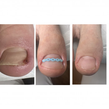 Klamra łańcuszkowa to natychmiastowa ulga przy wrastającym paznokciu! Ulubiona przez młodzież dzięki bogatej gamie kolorów – łączy skuteczność z modnym wyglądem. Komfortowa, estetyczna i bezbolesna w noszeniu!