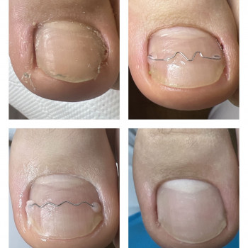 W trakcie terapii wrastających paznokci oferuję różne rozwiązania, m.in. klamry UniBrace i SinBrace. Każdego pacjenta traktuję indywidualnie, dobierając metodę najlepiej dopasowaną do potrzeb – dzięki temu terapia jest skuteczna i komfortowa.