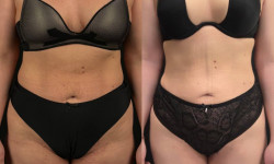 Пластика ягодиц Klinik für Plastische Chirurgie  Эталон Moscow